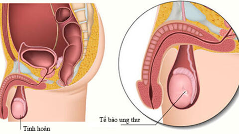 Ung thư tinh hoàn - nguyên nhân - cách điều trị khỏi bệnh ung thư tinh hoàn