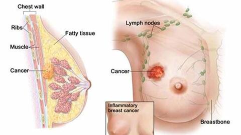 Dấu hiệu ung thư vú