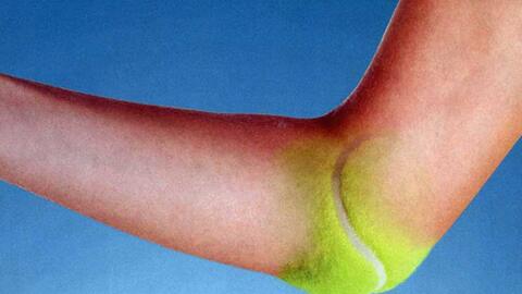 Chữa đau khuỷu tay trong tennis elbow (Phần I)