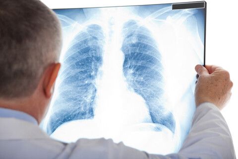 Điều trị thành công ung thư phổi