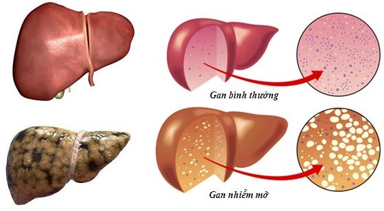 gan-nhiem-mo